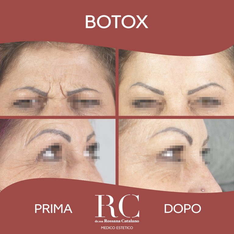 Botox Prima e Dopo - Rossana Catalano, Civitavecchia